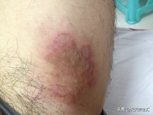 男性根部潮湿瘙痒用什么药,男性腿两侧根部瘙痒用什么膏药