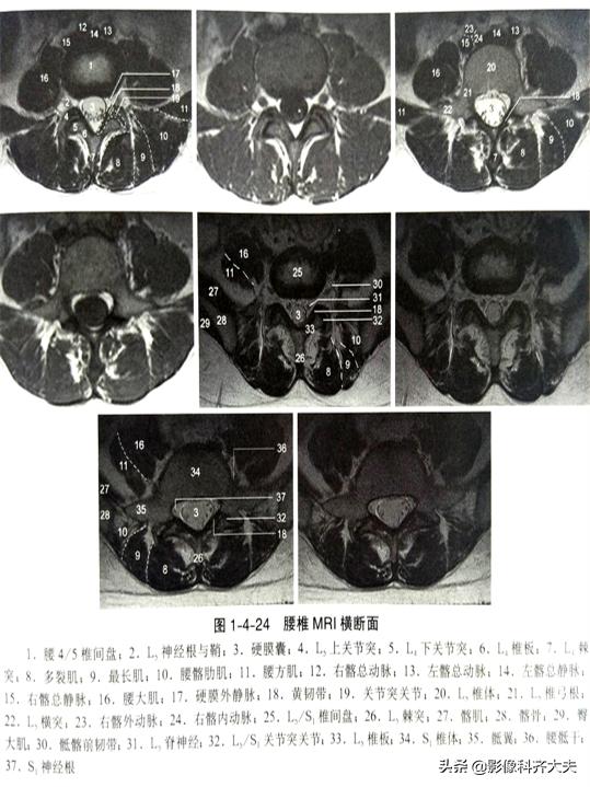 腰椎间盘突出最好的影像诊断方法,腰椎间盘突出的影像学检查