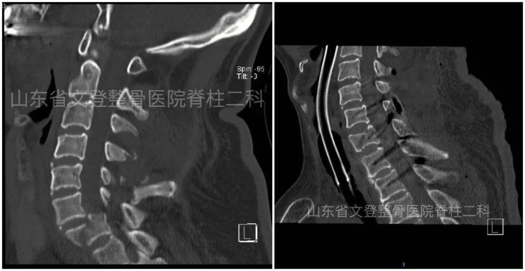 文登整骨医院治疗截瘫,山东文登整骨医院治疗怎么样