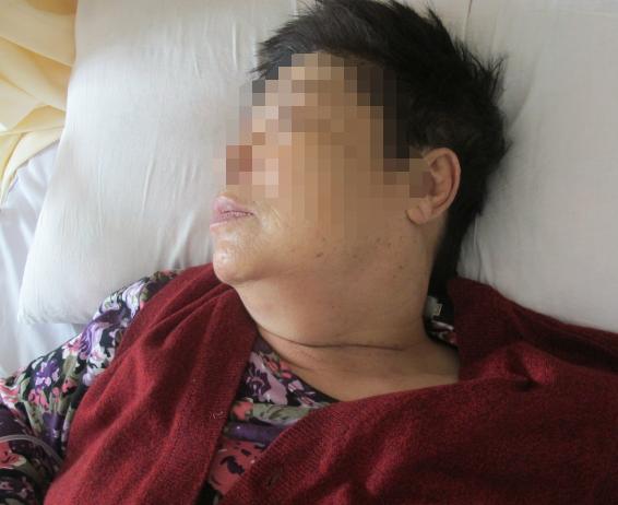 颈椎术后脑脊液漏取什么体位,脊髓型颈椎病手术后植骨愈合时间