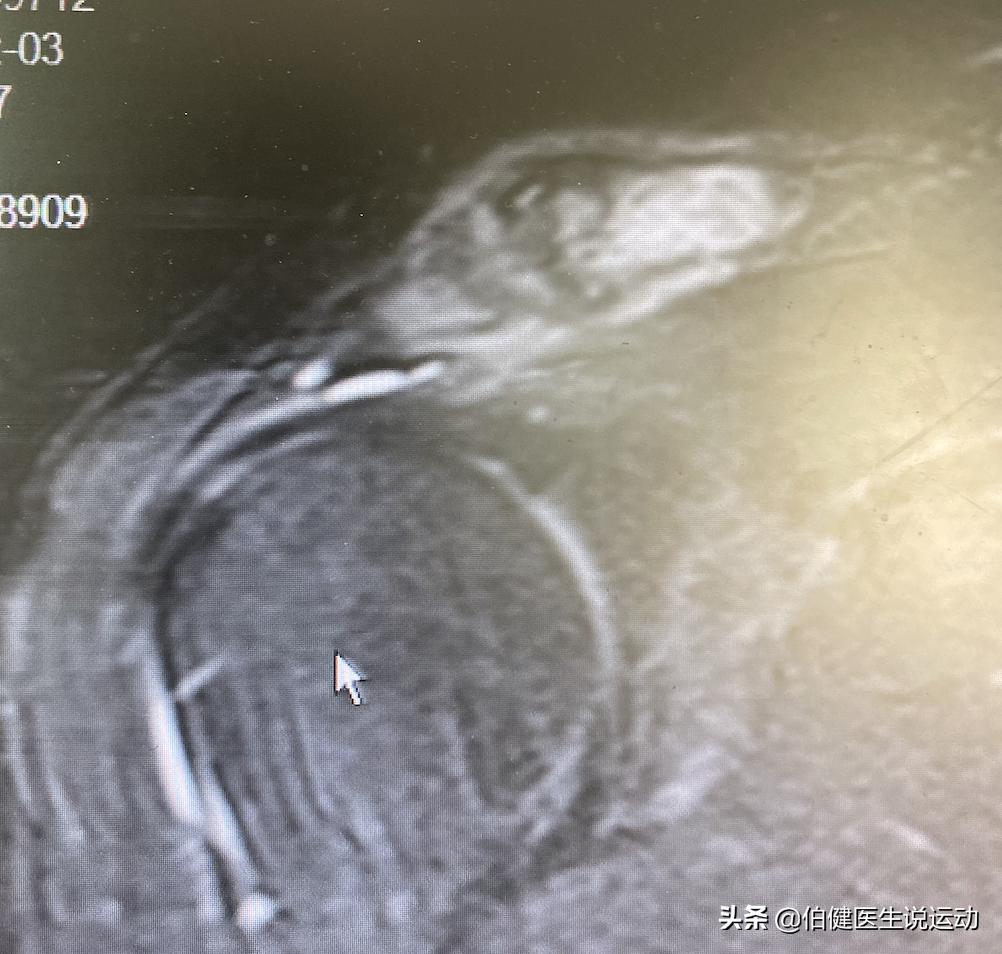 再论肩峰凸起的原因,肩峰凸起是怎么造成的