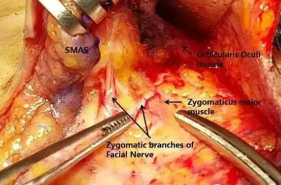 小拉皮和线雕哪个抗衰老效果好,最厉害的拉皮抗衰老技术
