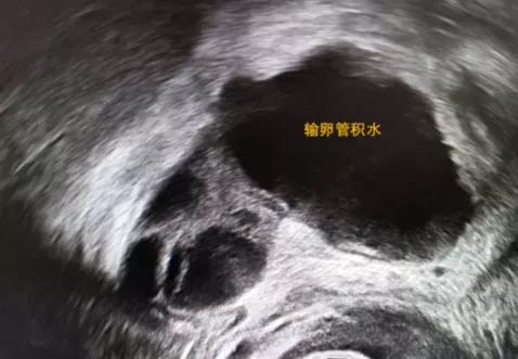 输卵管积水到底该怎么处理?