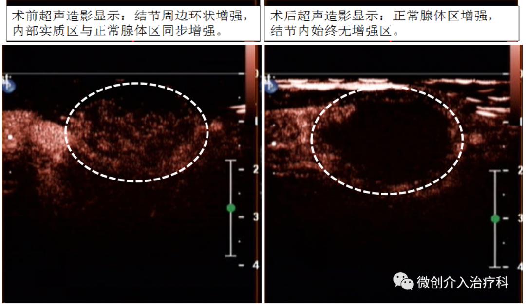 甲状腺结节微创消融手术,甲状腺结节微创消融医保