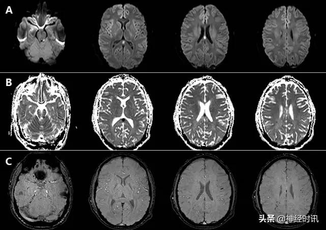 脑卒中病历诊断书图片,脑卒中影像判断技巧图解电子版