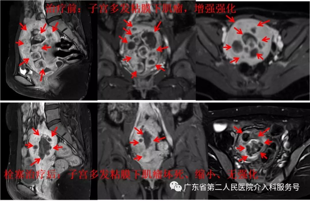 子宫多发肌瘤，月经量超多，重度贫血需输血，如何保宫治疗？
