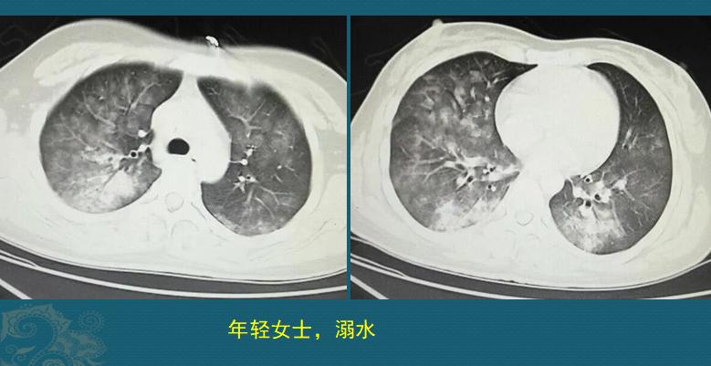 溺水后需要注意哪些事项,夏季溺水怎样防控
