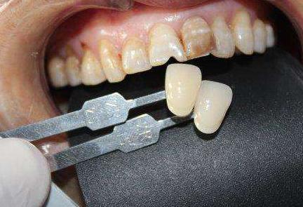 牙齿松动种植什么牙齿好,牙齿松动拔牙后镶和种植的区别