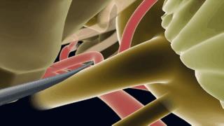 三叉神经痛有高龄老人吃的药吗,老人三叉神经脸部疼痛