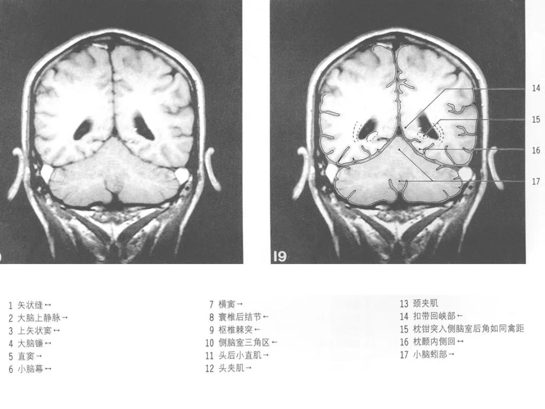 颅脑冠状状切面解剖图,颅脑mr解剖结构图