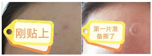 有效祛痘印的痘痘贴,祛痘痘的药膏明星