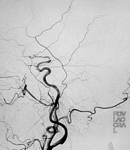 卢旺盛：脉瘤和基底动脉动脉瘤裸栓治疗术后效果非常明显