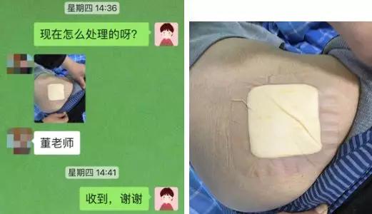 压疮敷料的选择及使用,褥疮敷料的正确使用方法