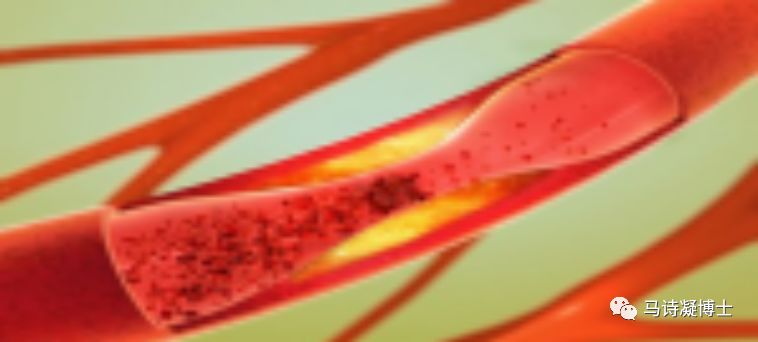 科普颈动脉斑块,科普下肢动脉硬化闭塞