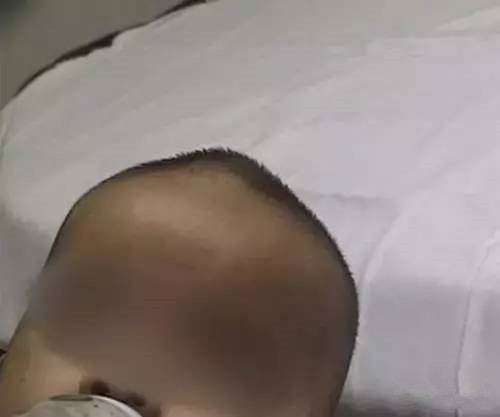 宝宝囟门之前是平滑现在凹陷,宝宝头顶的囟门宽正常吗