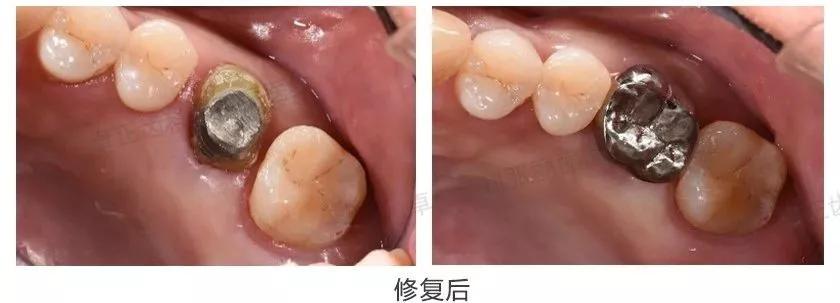 牙齿楔状缺损修复图片,牙齿楔状缺损修复大概多少钱