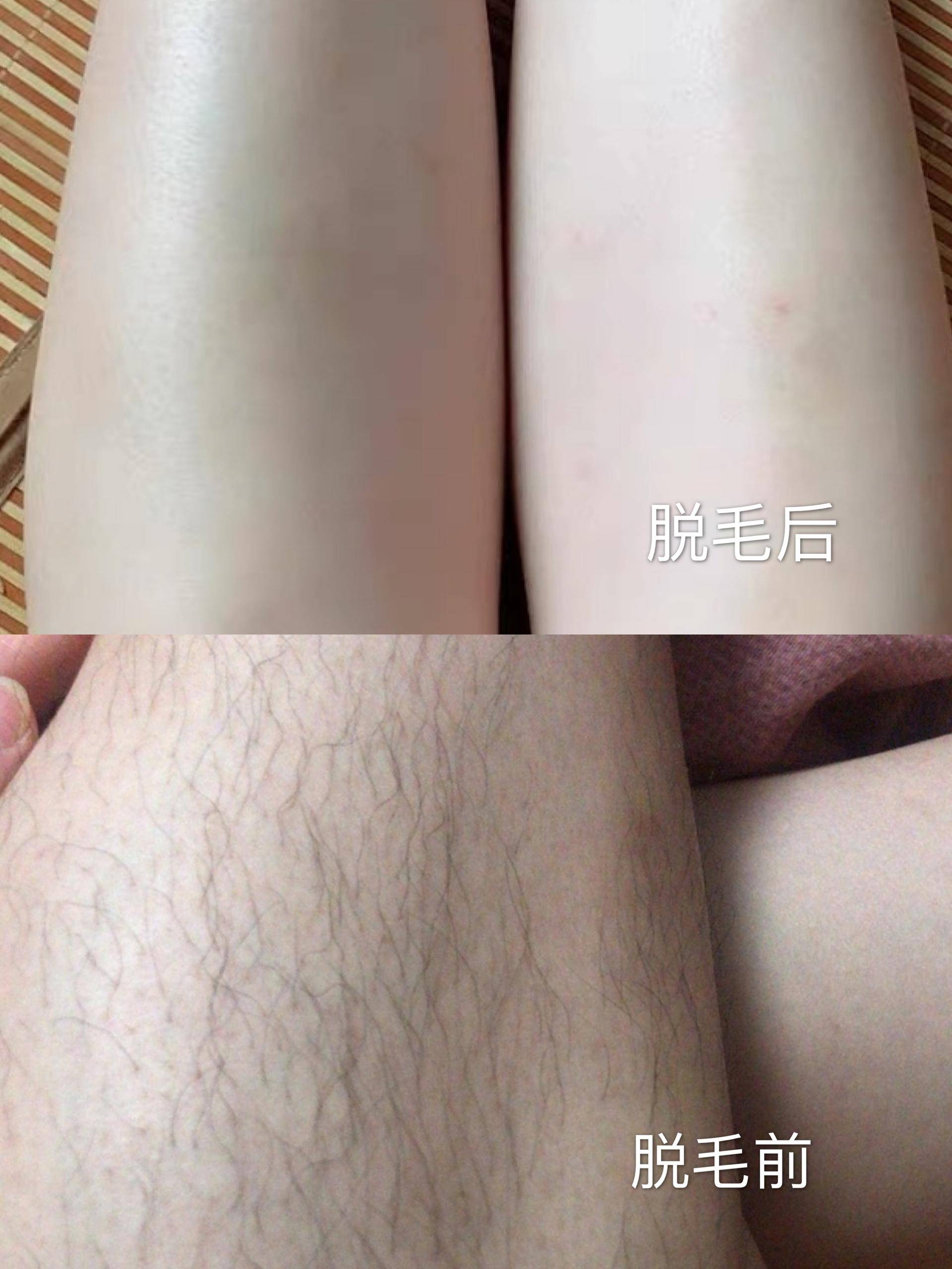 用脱毛仪之前体毛要刮到多少,女生体毛多用脱毛仪还是激光