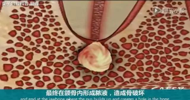 上牙龈上火突出一个鼓包,牙龈肿胀鼓包上火了吗