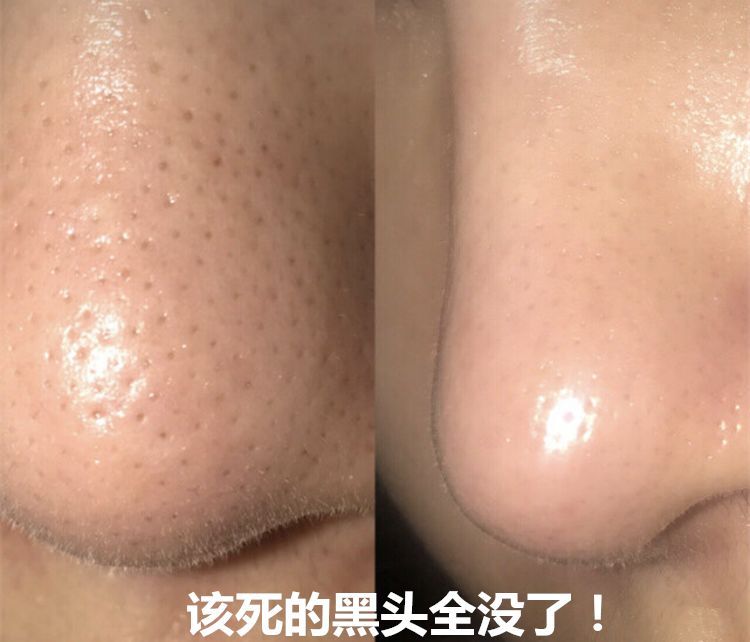 家用便携可视化祛黑头仪,金稻可视化吸黑头仪评测