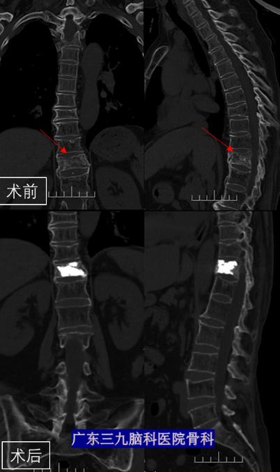 老年人骨头断裂是什么原因,老年人骨头断了怎么好得快