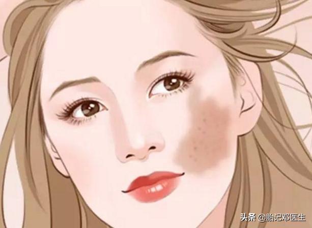 面容杀手,常见胎记的类型