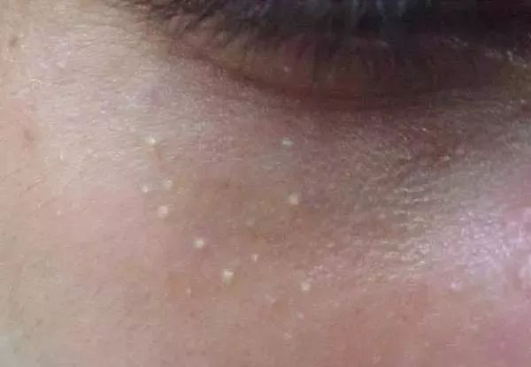 祛除闭合性粉刺软膏有哪些,下巴有闭合性粉刺怎么祛除