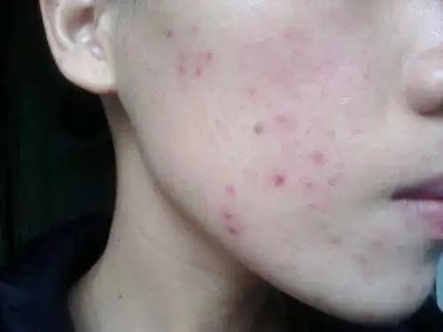 红痘印怎么医学处理,红痘印如何消除最快方法