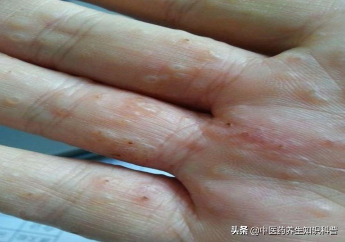 汗疱疹反复发作，怎么办？医生教你几招，帮你舒舒服服过夏天