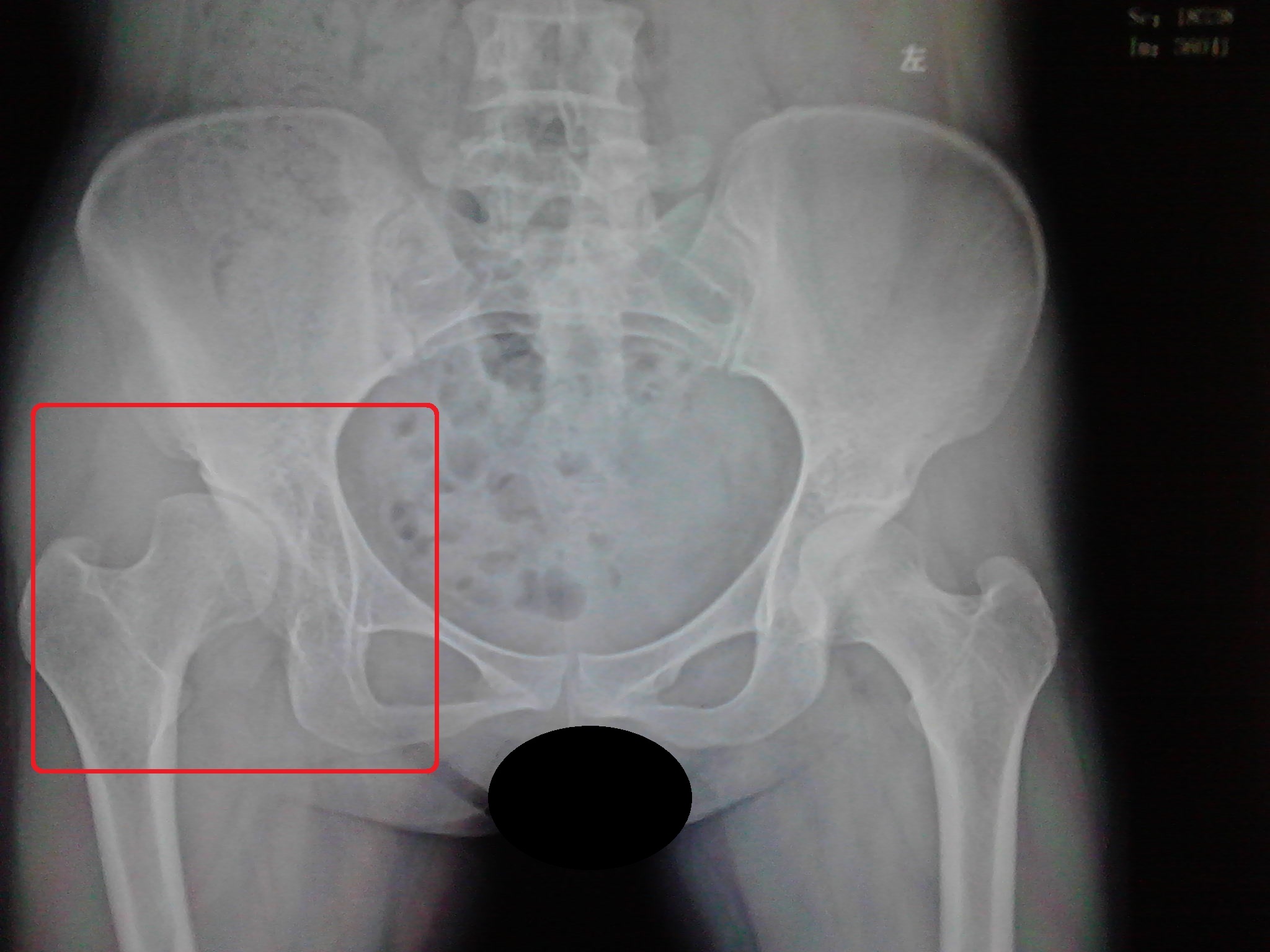 髋关节发育不良有什么拯救的方法,狗狗髋关节发育不良吃什么药