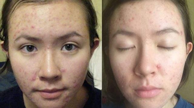 30块钱的“完美芦荟胶”，真的有祛痘效果吗？网友：不如自然乐园