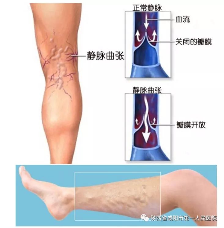 下肢静脉曲张微创手术是什么手术,下肢静脉曲张微创手术优点和缺点