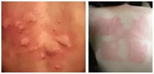 荨麻疹中医怎么问诊,荨麻疹的中医护理方案