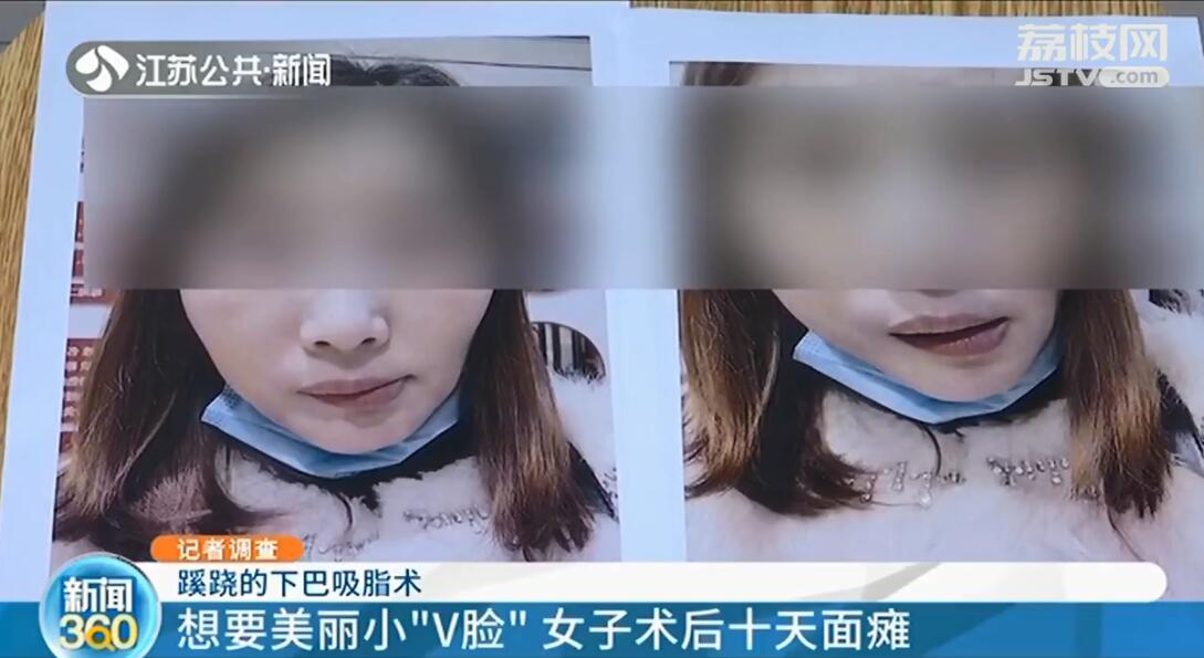 下巴吸脂手术真实经历,院长手术后续完整版