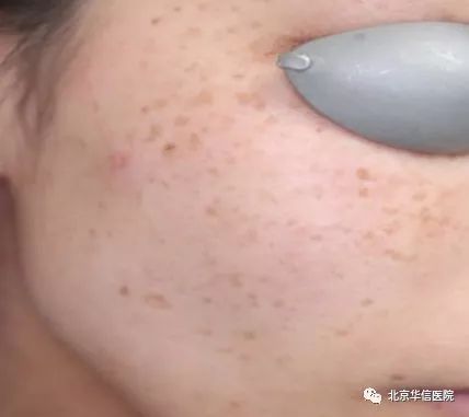 光子嫩肤唤醒肌肤活力重塑娇颜,光子嫩肤让你焕颜一新