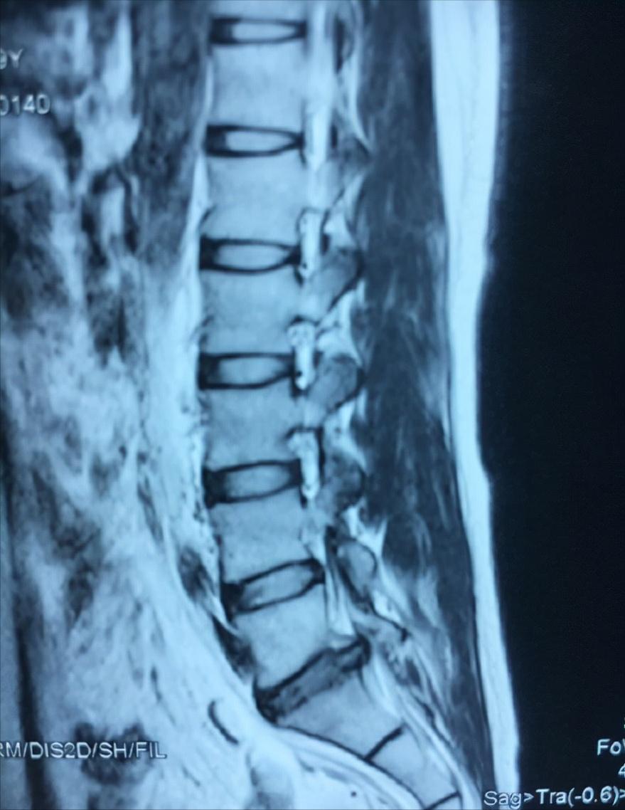 腰椎间盘突出症治愈的病例,老大爷教你治疗腰椎间盘突出
