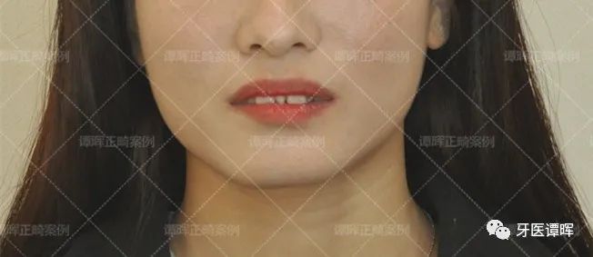 门牙前突+牙齿不齐矫正案例分享