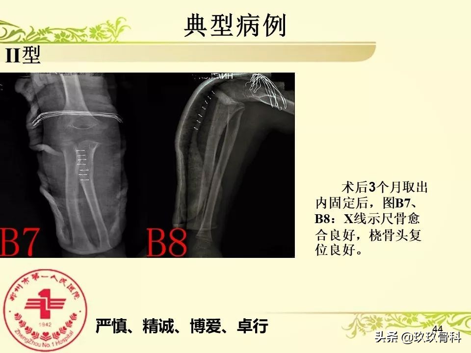 孟氏骨折功能训练多久能恢复正常,孟氏骨折中医能治吗