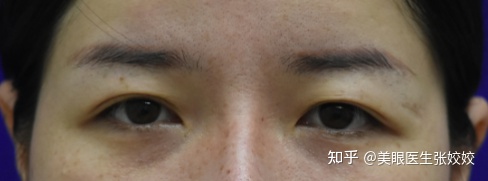 埋线双眼皮两边不对称怎么办,埋线双眼皮不对称修复方法