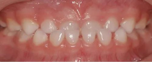 三岁孩子矫正牙齿后又反复,孩子牙齿矫正一个月看不到效果