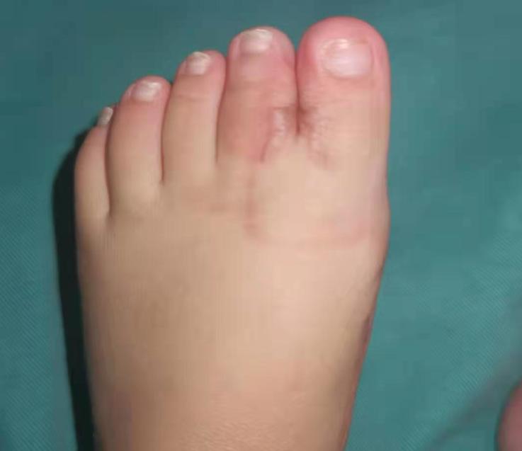 并指畸形免植皮案例,并指畸形