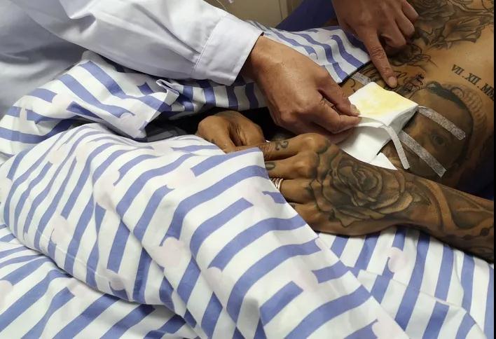 卡兰加脾脏摘除,卡兰加恢复出院