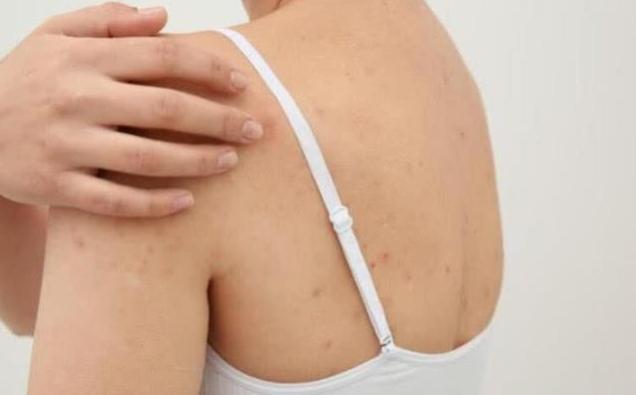 后背痘痘太厉害，露背装变“露痘装”，6个习惯，夏天轻松穿吊带