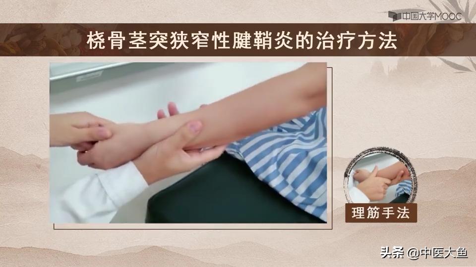 桡骨茎突狭窄性腱鞘炎怎么治疗,桡骨茎突狭窄性腱鞘炎治疗方法