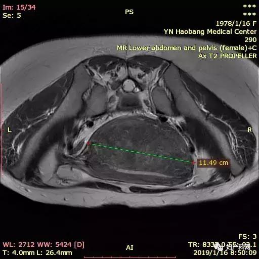 无症状子宫腺肌症可以不治疗吗,微无创超声介入