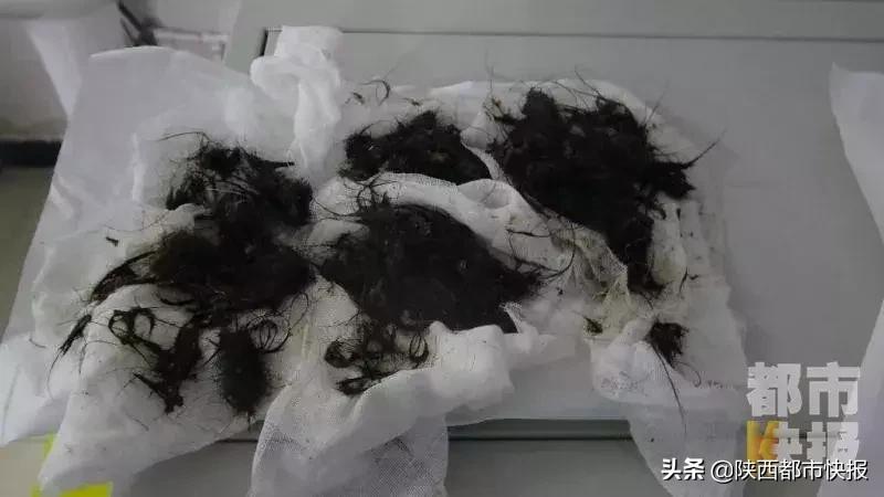 西安一女孩吃头发,86岁女童胃里取出2斤头发