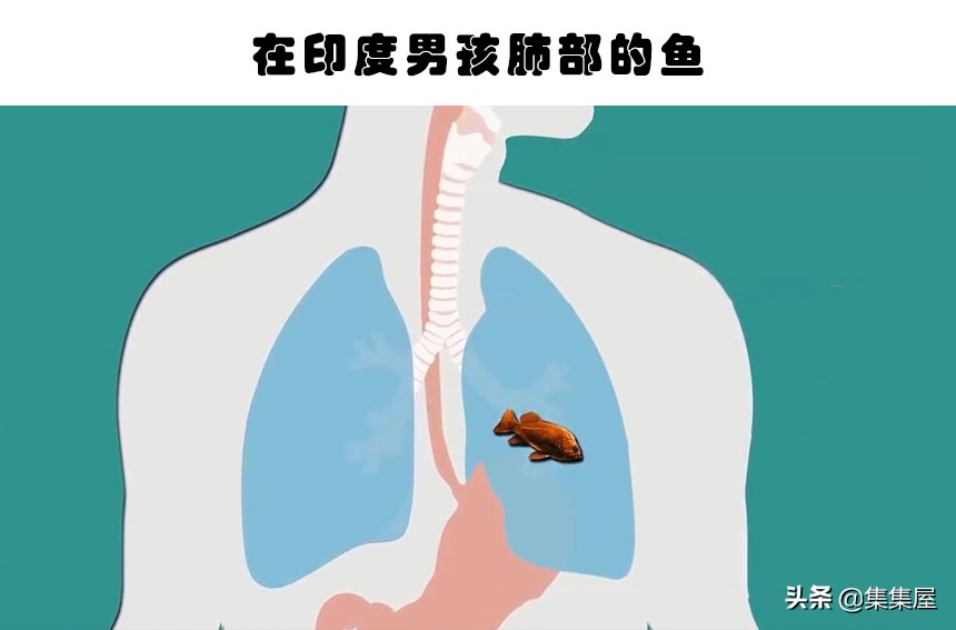 在人体内发现的6个难以用常理解释的物体