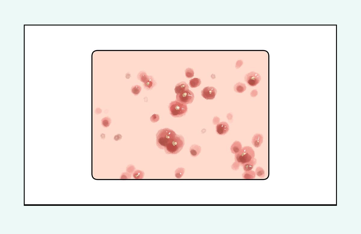 脸上的红疙瘩怎么彻底消除,脸上红疙瘩的种类