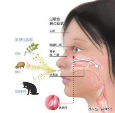 儿童鼻炎和哮喘断根最简单的方法,小孩鼻炎和哮喘怎么治