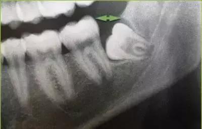 智齿发炎过程中为什么不能拔,智齿有发炎的经历了不拔可以吗