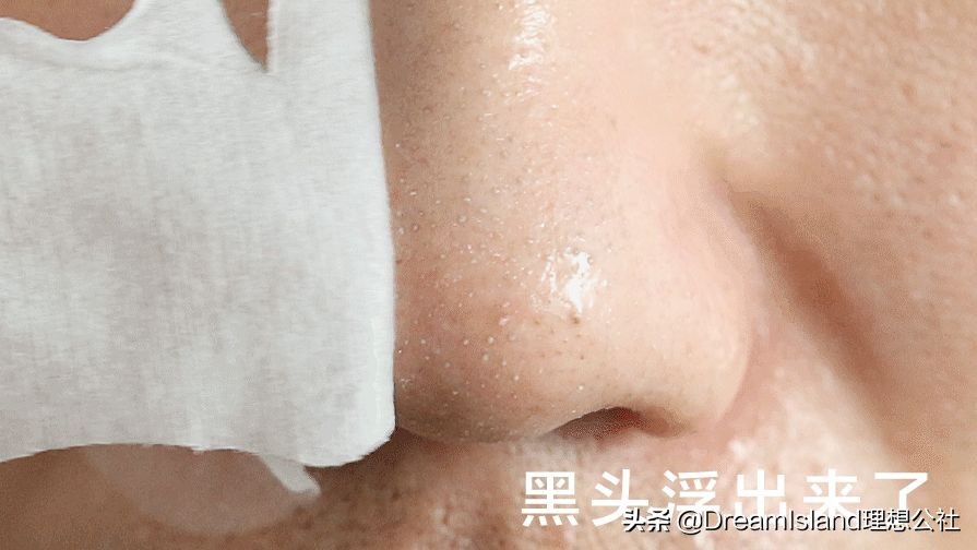 如何从根本上解决黑头问题,黑头太顽固教你去黑头的方法